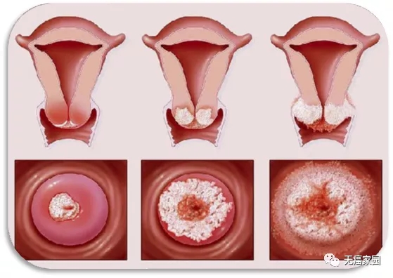 681)宫颈癌03,妇科肿瘤所有保乳术后患者均