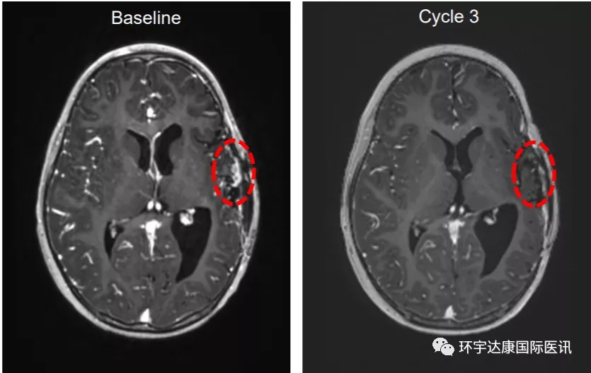 TPX-0005治疗3岁脑胶质瘤案例
