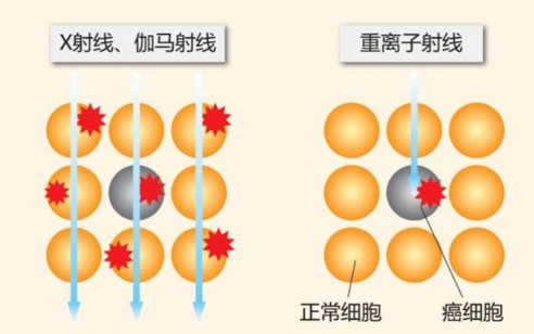 质子重离子疗法,质子重离子可以治疗哪些肿瘤癌症