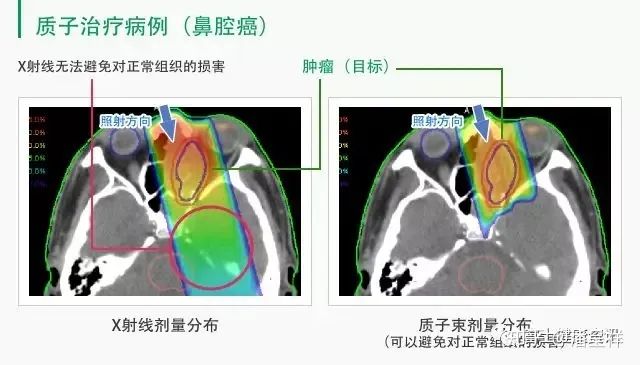 X射线和质子治疗对比