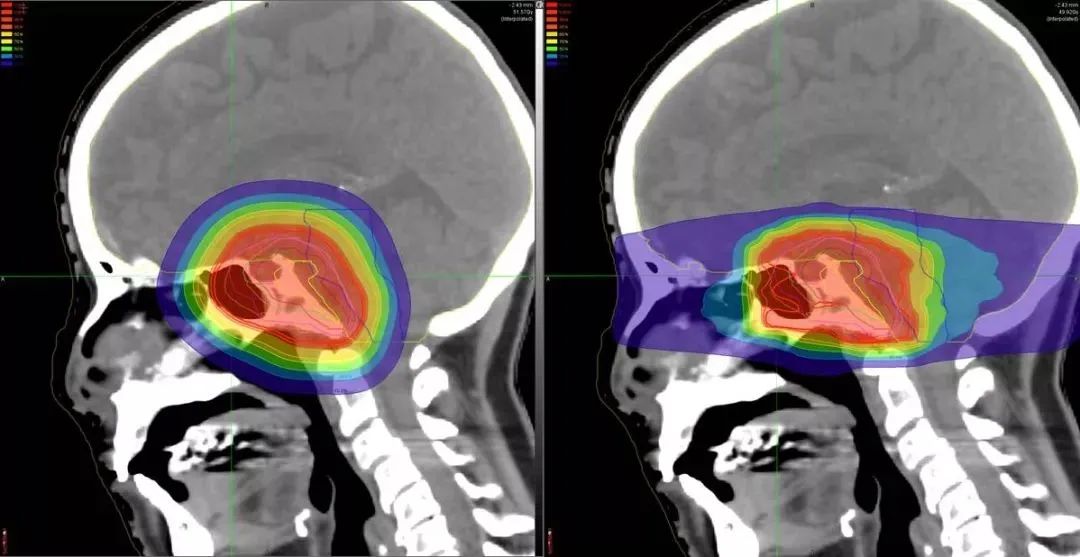 头颈部肿瘤质子治疗和传统放疗对比