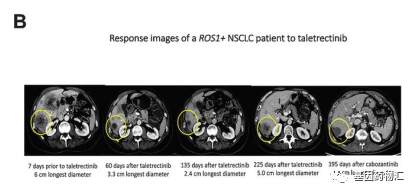 耐药患者78.9%疾病控制,初治缓解率92.5%!他雷替尼获ROS1非小细胞肺癌
