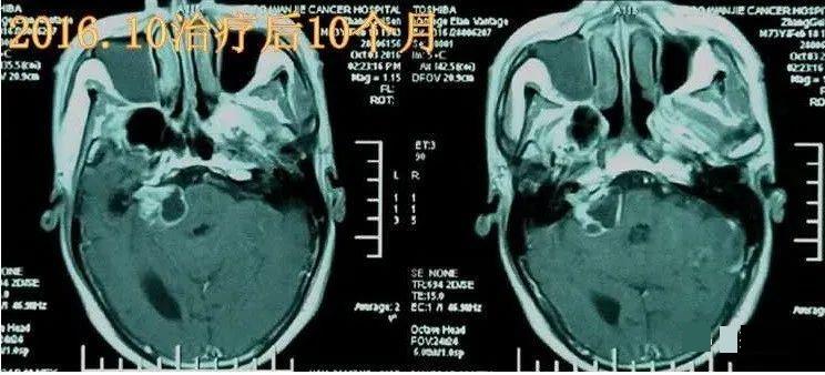 质子治疗听神经瘤10个月后
