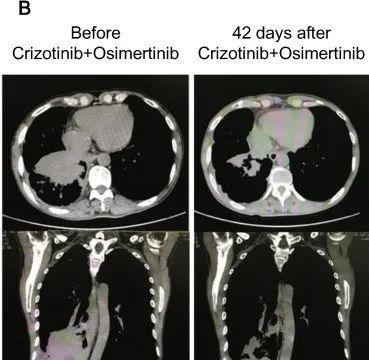 奥希替尼联合克唑替尼治疗MET扩增的效果