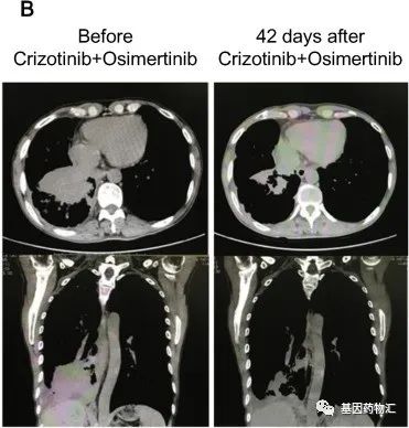 奥希替尼耐药案例3则:最简单的1+1就能对抗耐药吗?看看这些患者案例吧
