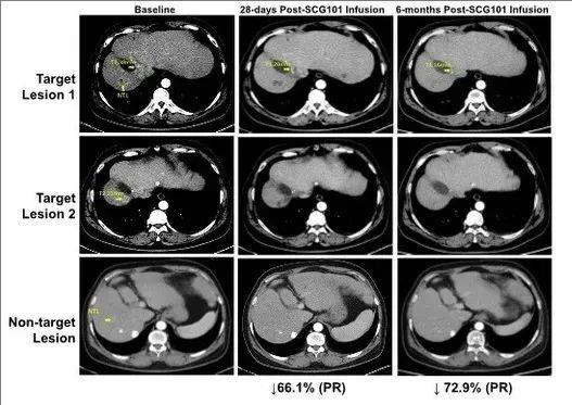 TCR-T细胞疗法SCG101治疗肝癌的效果