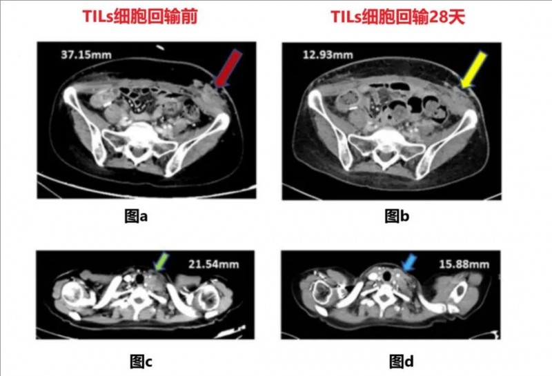 GT300 TIL细胞疗法治疗宫颈癌的效果