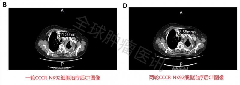 CAR-NK治疗肺癌的效果