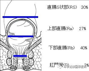 确诊肠癌后先别着急切!看看日本的高水平精密手术是如何做的