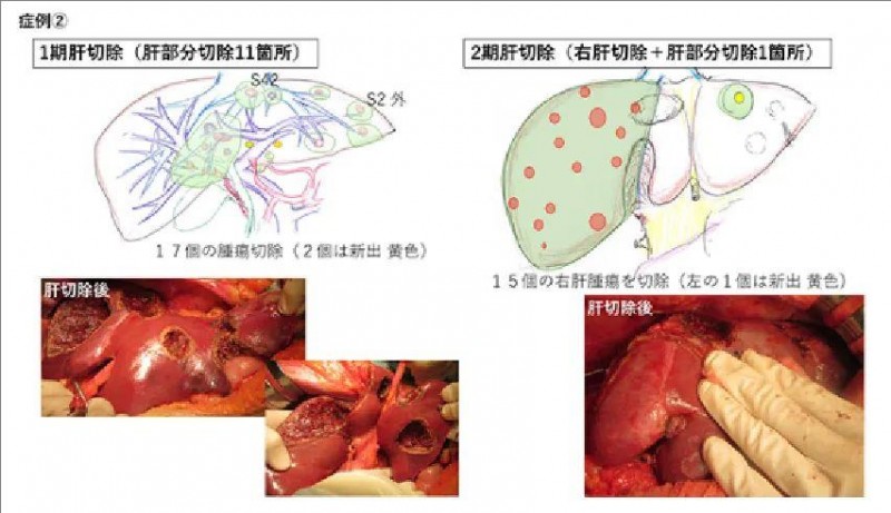 日本肠癌肝转移手术