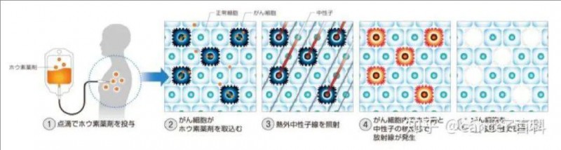 日本BNCT治疗流程