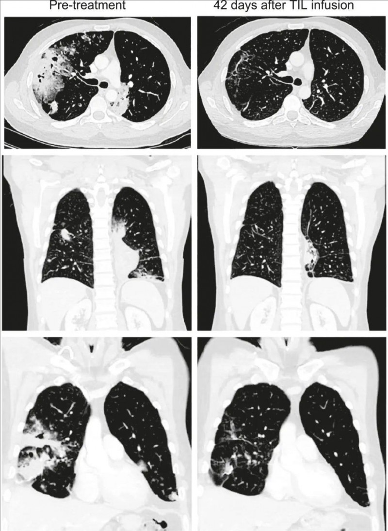 TIL疗法治疗肺癌的效果