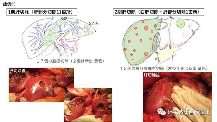 难治的稀有突变型就要用“特效药”！我国自主研发JMT-101再战非小细胞肺癌