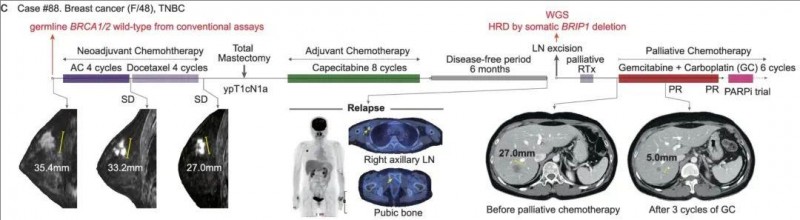三阴性乳腺癌利用基因测序确定病程的过程