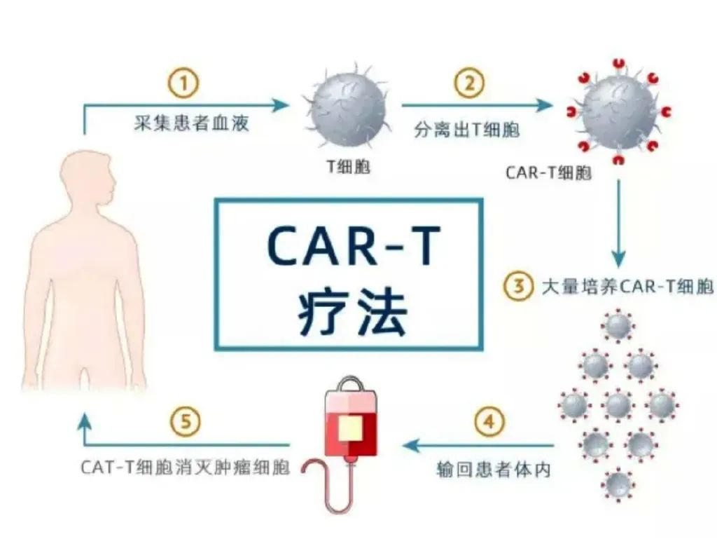 CAR-T细胞疗法的治疗流程