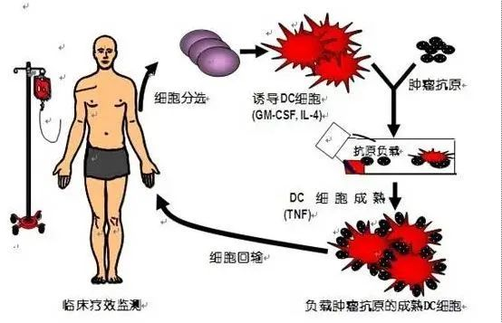 树突状细胞疗法治疗流程