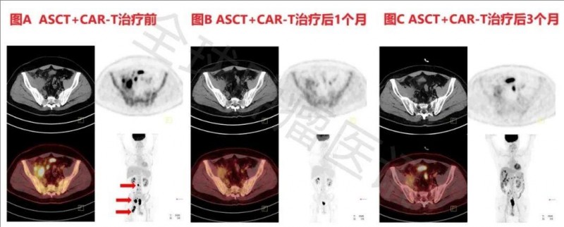 CAR-T治疗淋巴瘤的效果