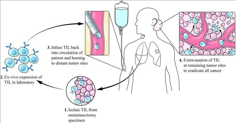 TIL细胞免疫疗法的治疗流程