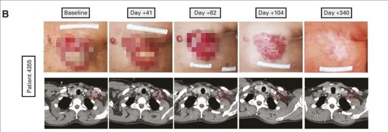 TIL细胞免疫疗法治疗转移性乳腺癌的效果