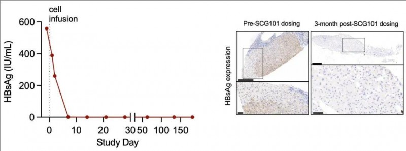 SCG101治疗肝细胞癌的HBV感染缓解率