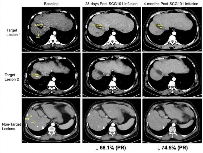 SCG101治疗肝细胞癌的效果