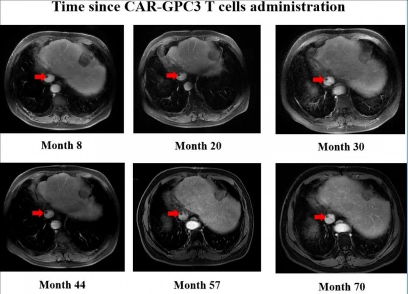 GPC3 CAR-T治疗肝细胞癌腔下静脉癌栓的效果