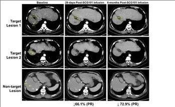SCG101治疗肝癌的效果
