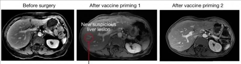 个体化新抗原Cevumeran疫苗治疗胰腺癌的效果