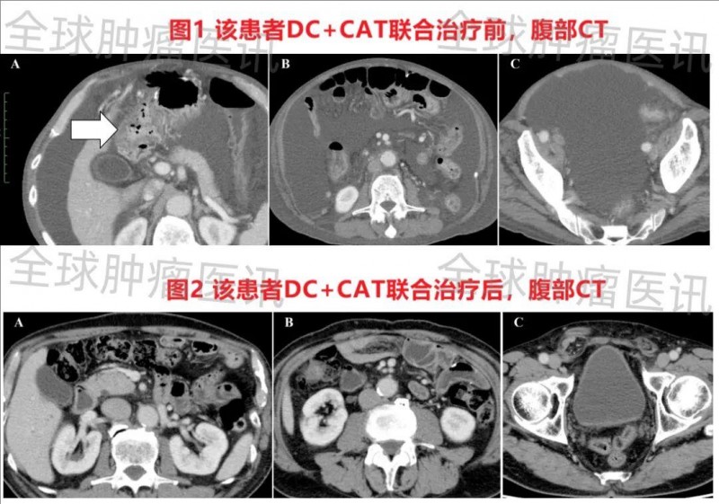 DC疫苗联合CAT疗法治疗肠癌的效果