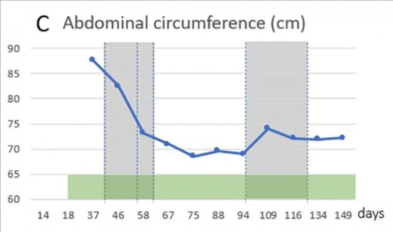 WT1-DC疫苗联合NK细胞疗法治疗卵巢癌的腹围变化