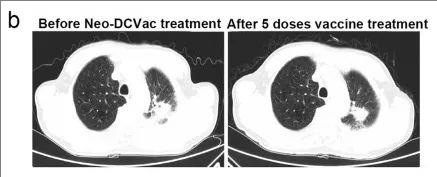DC疫苗Neo-DCVac治疗肺癌的效果