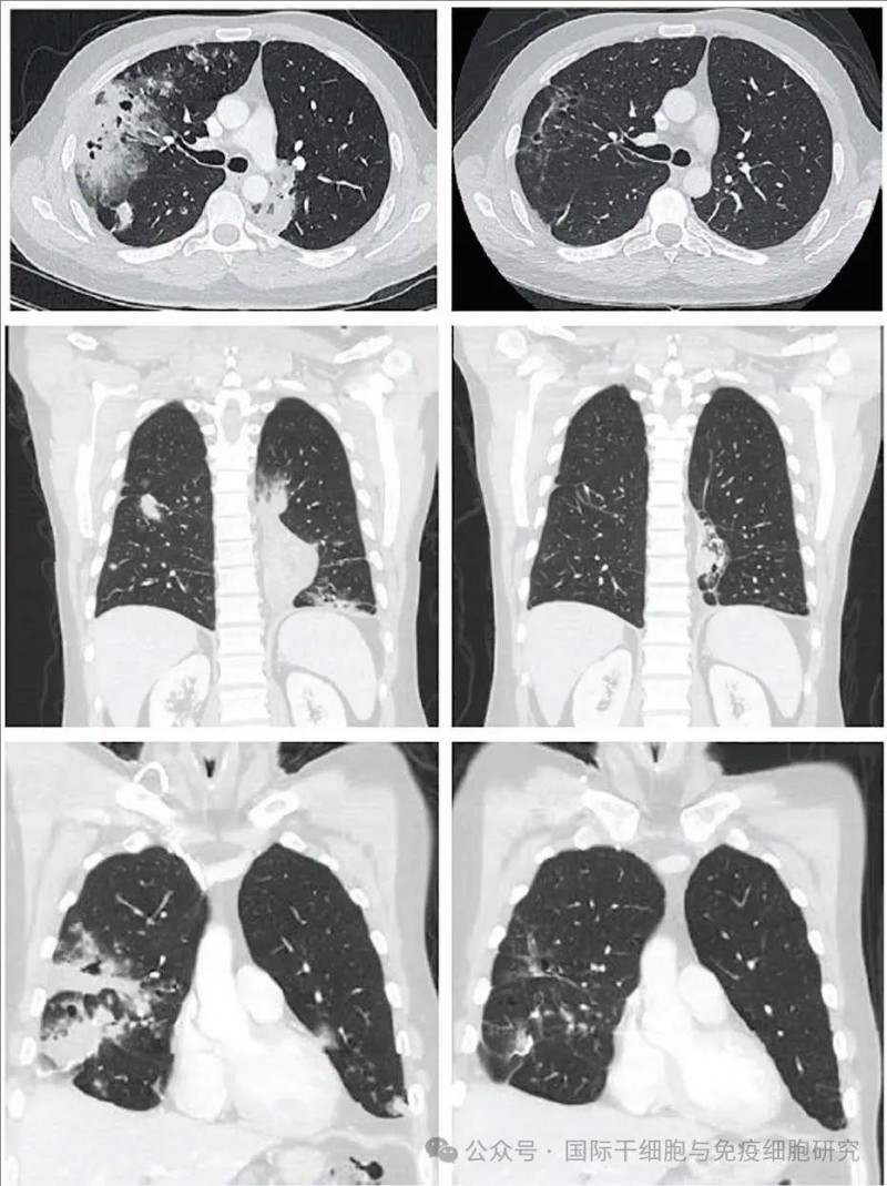 TIL细胞疗法治疗肺黏液腺癌的效果