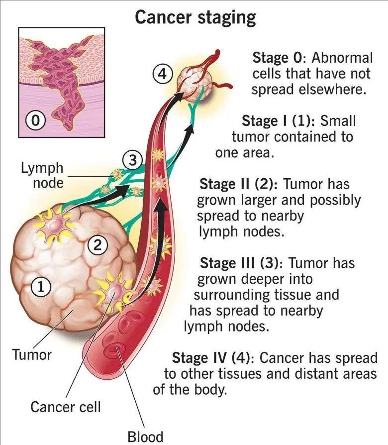 癌症患者不可不知的六大检测手段:严防复发/转移,筑牢健康防线