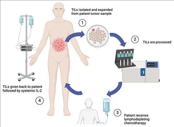 肿瘤大幅消退!免疫疗法无果后,TIL细胞以62.5%疾病控制率逆风翻盘,冲破癌症复发转移阴霾