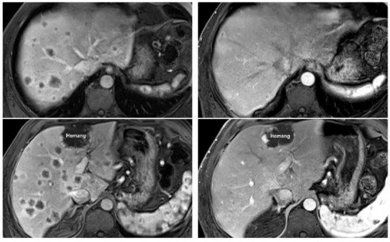 TIL细胞疗法治疗胰腺癌的效果