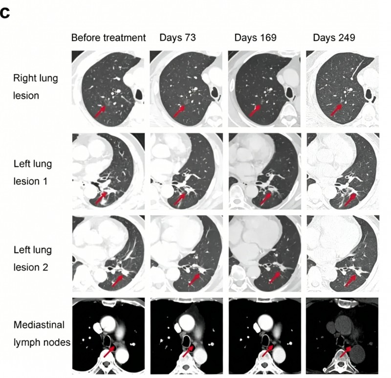 XP001治疗肺癌的效果