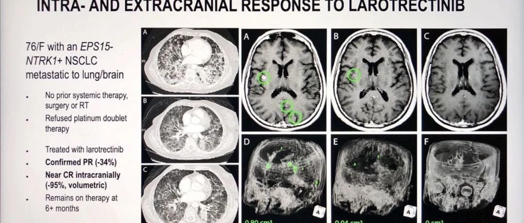 肺癌脑转移治疗新药拉罗替尼、恩曲替尼