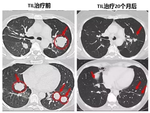 晚期胆管癌肝转移的患者til疗法治疗前后对比