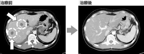 胰腺癌肝肺转移灶NK疗法治疗前后对比