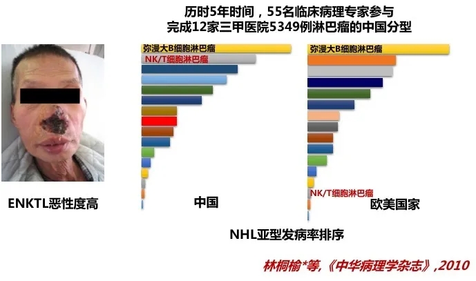 NK/T淋巴瘤患者