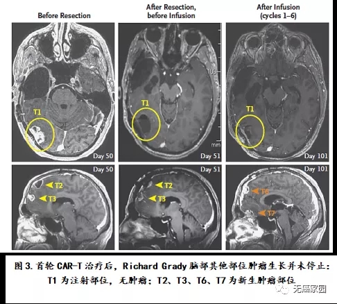 CAR-T细胞疗法治疗脑胶质瘤的效果