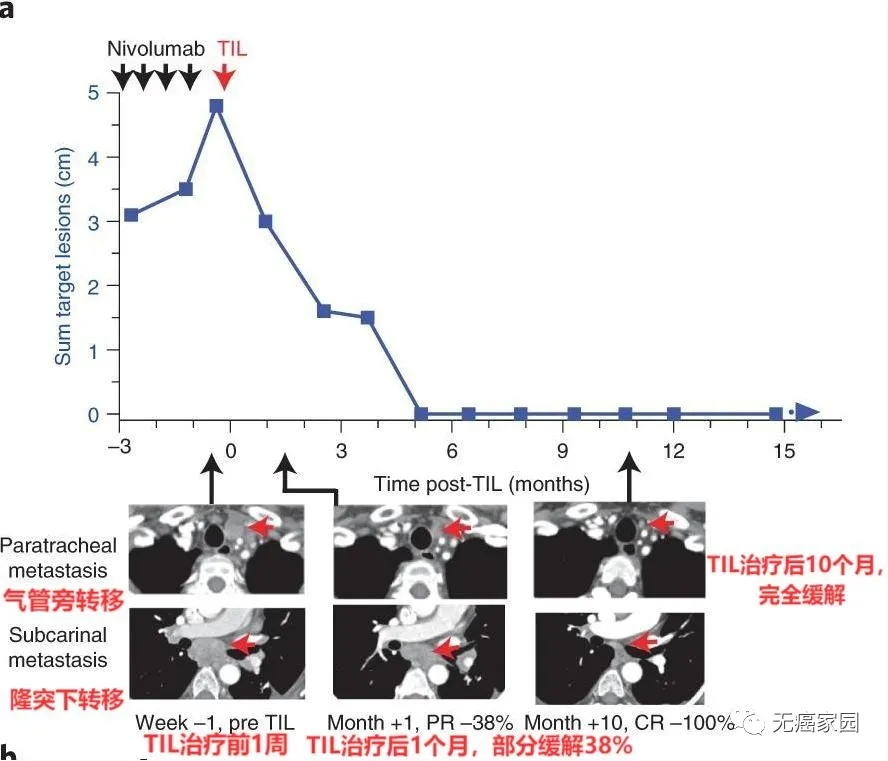 TILs疗法联合PD-1治疗肺癌案例