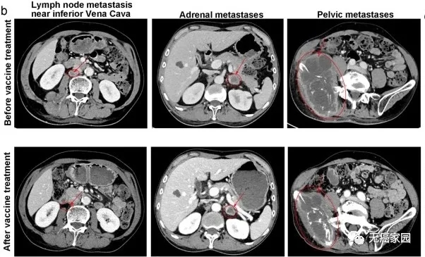 树突疫苗治疗肺癌肾上腺转移的效果