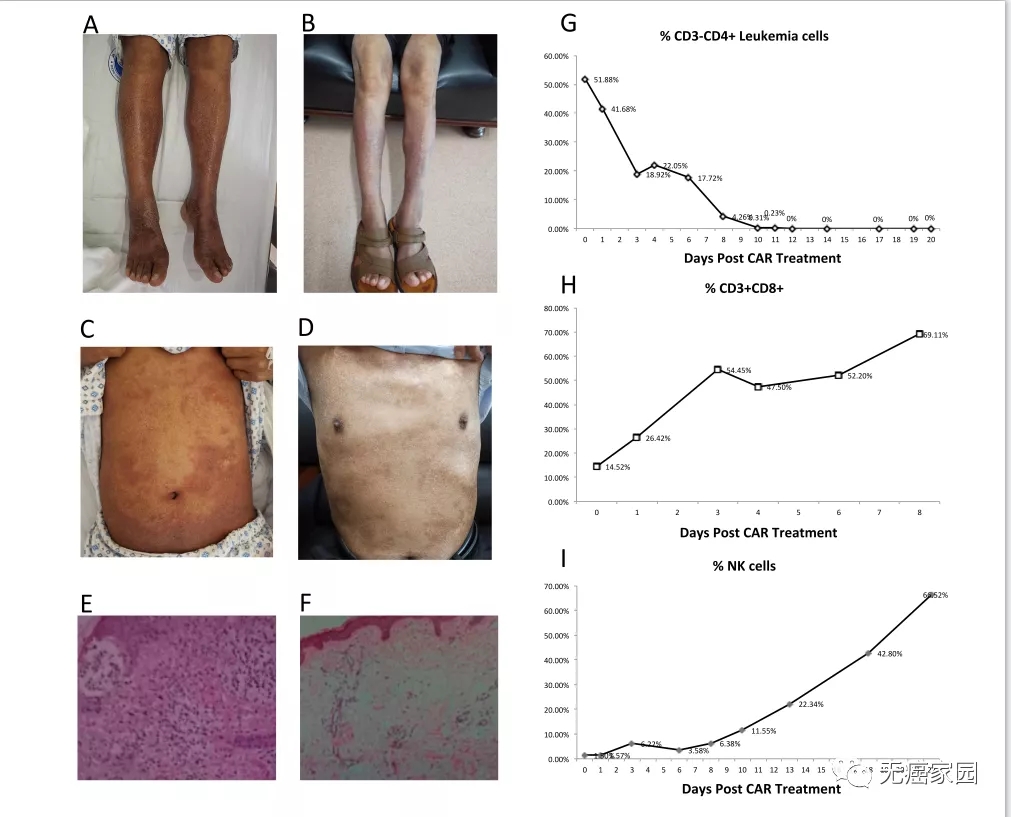 CAR-T细胞免疫疗法治疗白血病前后对比