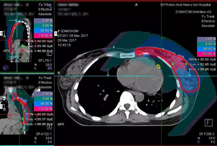 乳腺癌质子放疗剂量分布图