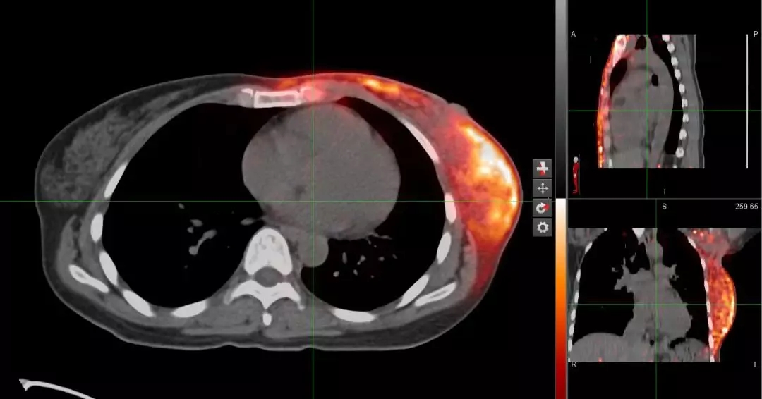 乳腺癌质子放疗后 PETCT剂量验证图