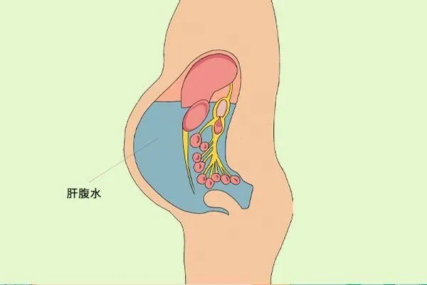 癌性腹水怎么治疗