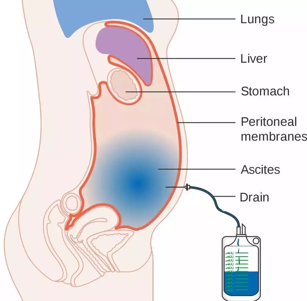 肿瘤患者出现恶性腹水怎么办?