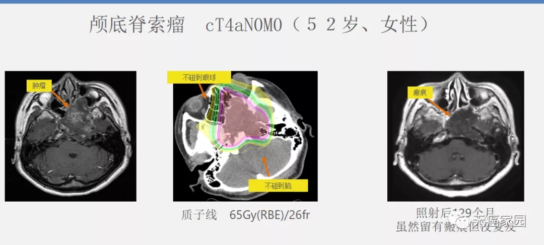 颅低脊索瘤质子治疗效果