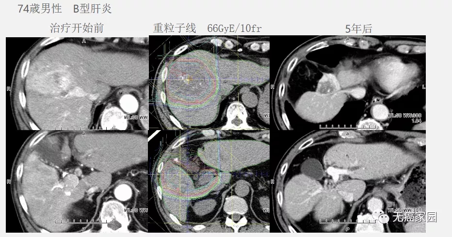 肝癌质子治疗效果